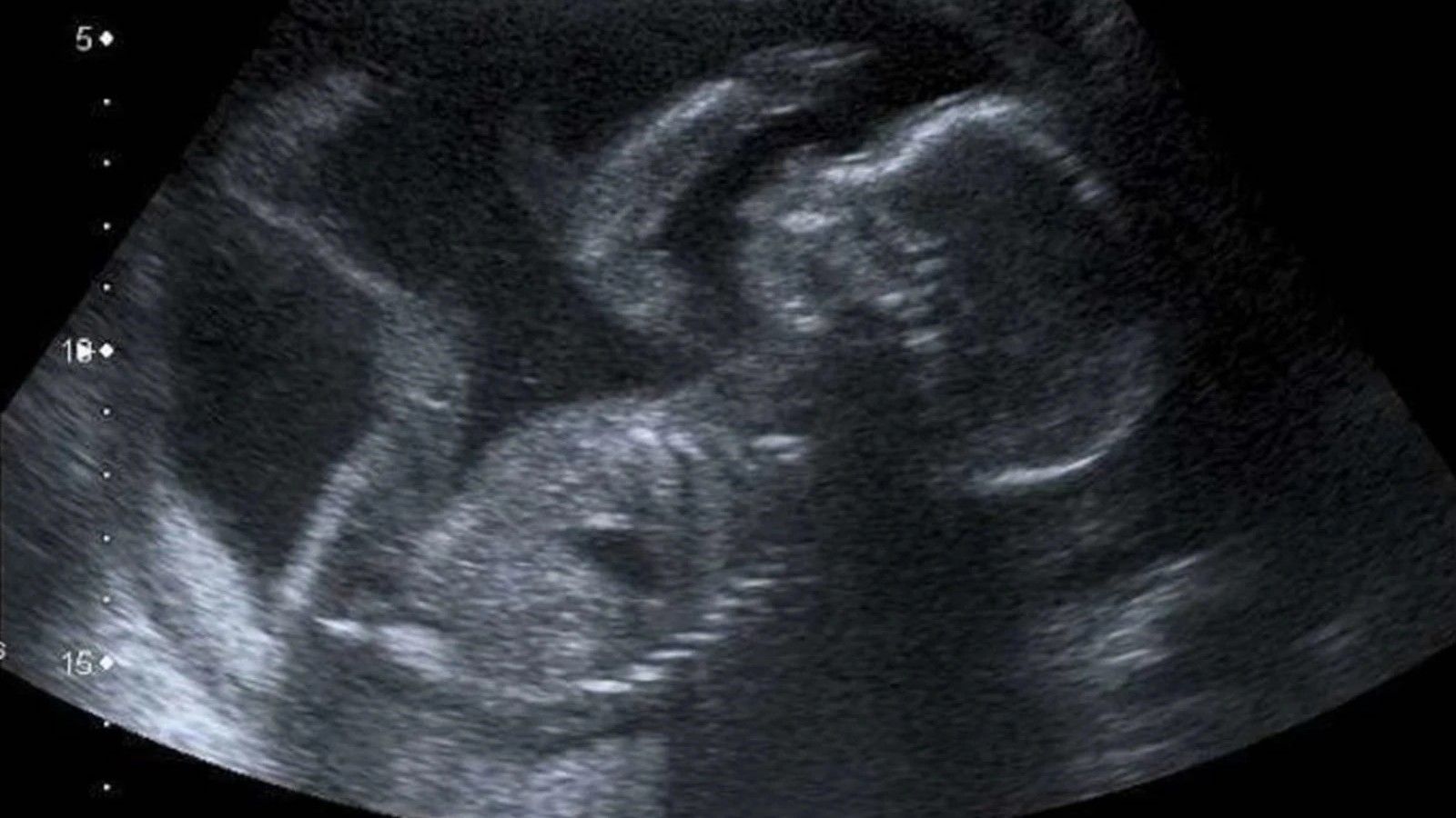 La financiación del aborto centra el debate en la Cámara de Representantes de Estados Unidos